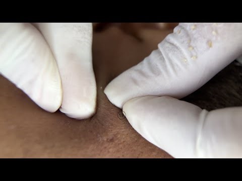 Cleaning Acne on Face