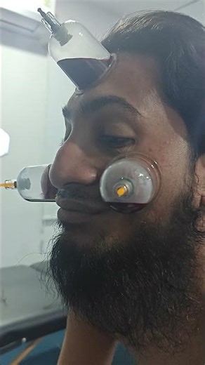 Facial Cupping For Acne#hijama#massage#cupcure#cuppingtherapy#cuppingmassage#asmrvideos#asmrsounds