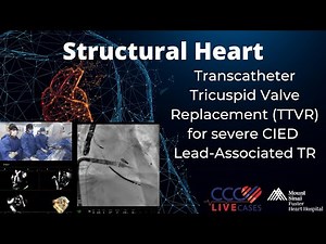 Transcatheter Tricuspid Valve Replacement (TTVR) for severe CIED Lead-Associated TR