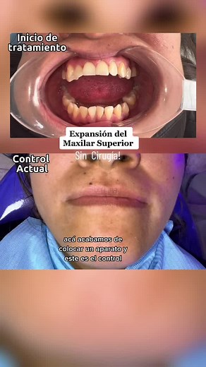Caso de Mordída abierta y atresia del Maxilar Superior….la expansión del Max. superior en pacientes adultos claro que es posible y nos ayuda a resolver mordidas cruzadas, asimetrías faciales 😉✅#expansionmaxilar #marpe #mordidaaberta