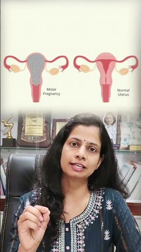 Understanding Molar Pregnancy and it's type. Dr. Nisha Mangal