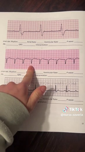 Just becuase the qrs seems in better doesn't mean you can't interpret it. Follow the same steps! It just looks this way depending on which lead/vector we are reading the strip from and which direction the electrical impulse is going towards. #ekg #ecg #ekginterpretation