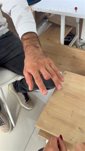 22K views · 2.2K reactions | Our personalized prosthesis application朗 Our patient came to our center from Kocaeli in Türkiye for prosthesis application奈 Let him use his prosthesis on beautiful days﫶﫶﫶 #siliconefinger #fingerprosthesis #parmakprotezi | Hacer Kılıç | Facebook