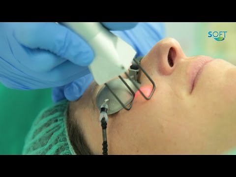 Blefaroplastia laser