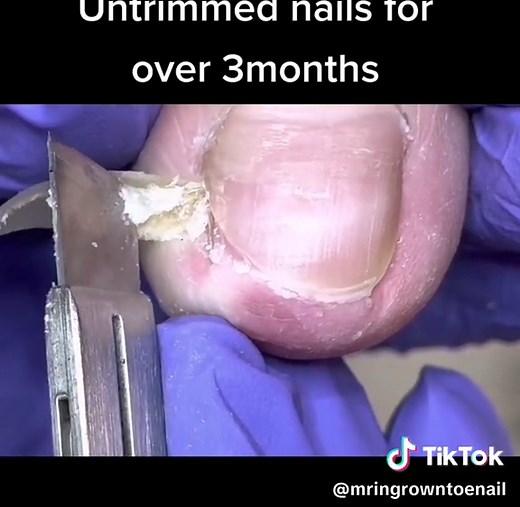 #fy #fyp #fypシ #podologia #tiktokusa #ingrowntoenail #ingrowntoenailremoval #podiatry #podiatrist #pedicure #pedicuredoctor #feetcare #dirtyfeet