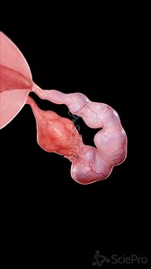 ⚠️ Hydrosalpinx: Blocked & Fluid-Filled Fallopian Tubes ⚠️ Hydrosalpinx occurs when a fallopian tube becomes blocked and fills with fluid, preventing the egg from traveling to the uterus. This condition is a common cause of infertility and can result from infections, inflammation, or prior surgeries. 🔹 What Causes Hydrosalpinx? Pelvic Inflammatory Disease (PID) Endometriosis Previous pelvic or tubal surgery Sexually transmitted infections (STIs) Tubal ligation complications 🔹 Symptoms to Watch