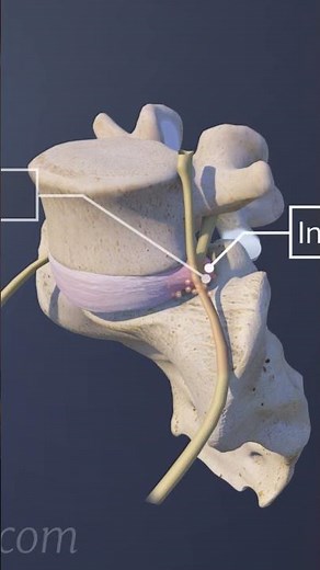 Can a small hip tear cause big pain? Learn how it affects movement and what to do