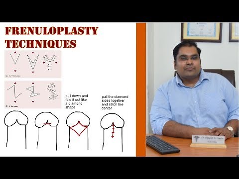Frenulopasty techniques for Frenulum Breve - VY Plasty, Z Plasty, Stitchless