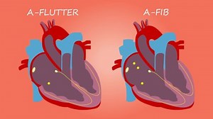 Heart Atrial Fibrillation Versus Flutter Medical Stock Footage Video (100% Royalty-free) 1088936355 | Shutterstock