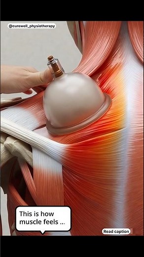 Cupping Therapy: Muscle Response & Myofascial Release #shorts