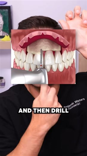 What actually causes a gummy smile and how dentists approach fixing it | TheBentistofficial