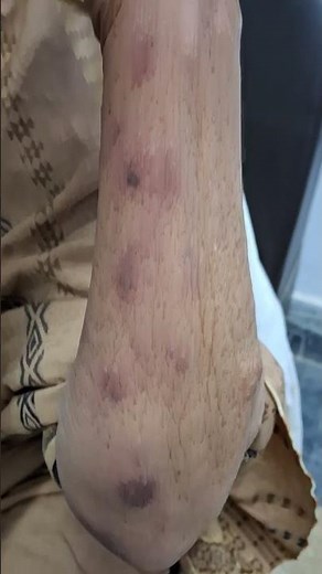 Erythema multiformi | Target lesions