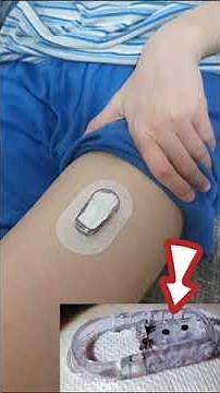 Colocando un Dexcom ONE