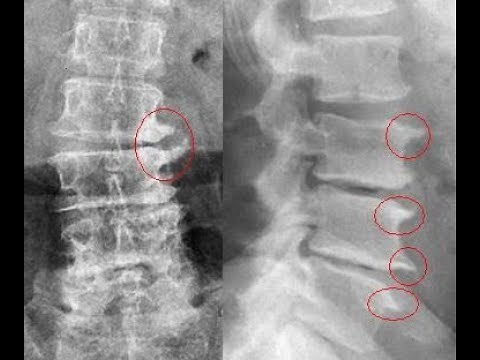 Parrot's Beak / Osteophytes Do You Feel Back Pain? Dr. Robson Sitta Physiotherapy Clinic