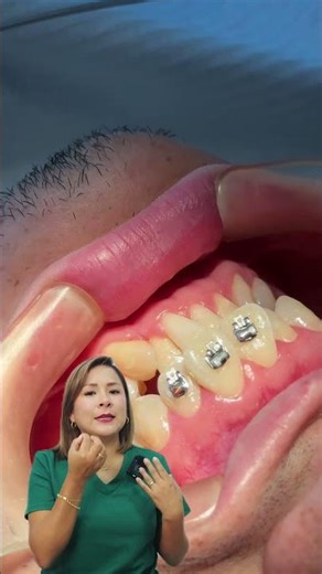 Así se pegan los Brackets (Paso a Paso) 🦷✨ #Shorts