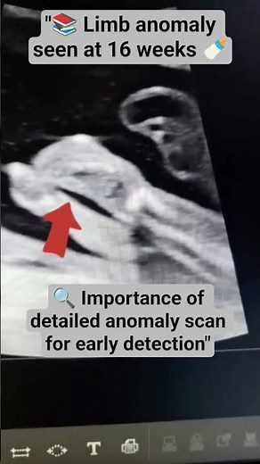 🧠 16 Weeks Baby Ultrasound – Detecting Missing Hand | Educational Scan #ultrasound