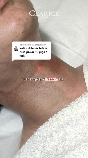 Perawatan Leher Hitam dengan Laser di Clarice Beauty