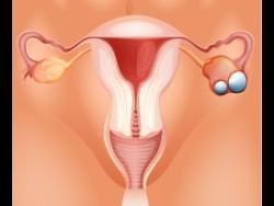 Ovarian cancer kills: Watch the signs