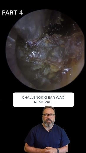 Effective Ear Wax Removal Methods - Part 4