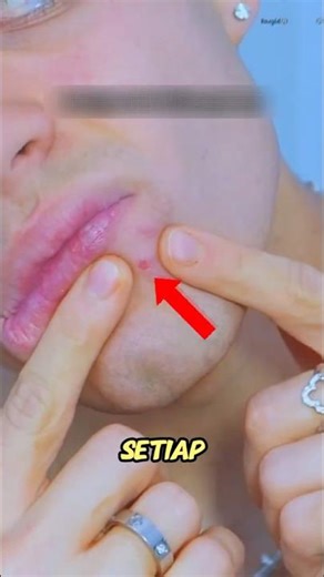 😱 Why Do Pimples Get Even More After Squeezing Them?