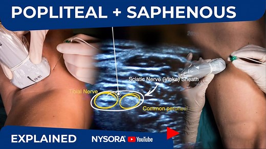 POPLITEAL + SAPHENOUS NERVE BLOCKS FOR ANKLE FRACTURE (VIDEO) - NYSORA