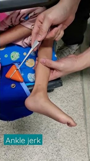 Hyperreflexia in a child with cerebral palsy #Shorts