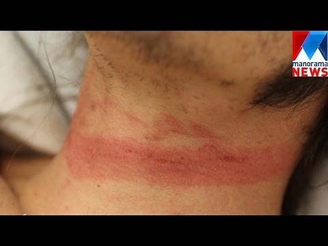 Postmortem Findings in Cases of Hanging and Ligature Strangulation | Manorama News