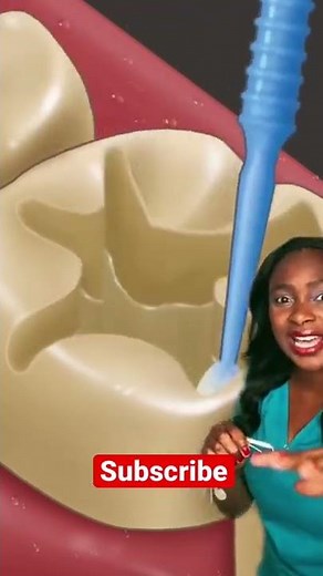 How a cavity is filled #shorts #animation