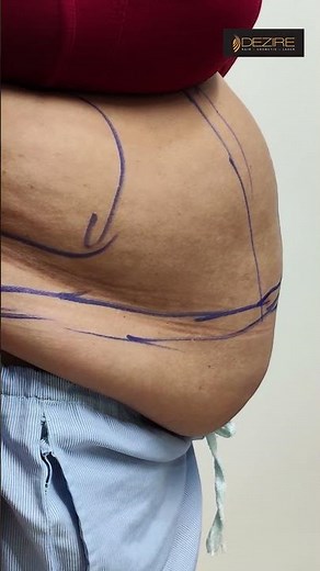 Tummy Tuck surgery