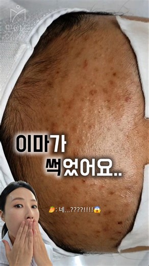"이마가 썩은 것 같아요..." 😱 (모낭염 vs 좁쌀여드름)