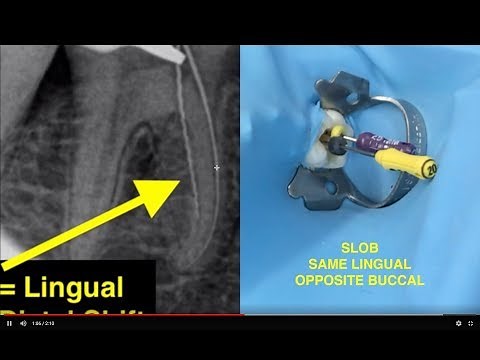 How to determine root canal working lengths with X-rays.