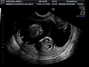 Ultrasound - triplets 12 weeks gestation