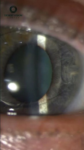 Iris Claw Lens Implant