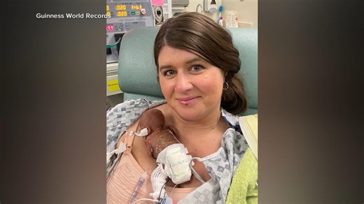 Baby dubbed ‘world’s most premature baby’ on 1st birthday by Guinness World Records