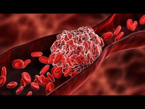 Blood Clots Explained: Recognizing, Treating, and Preventing DVT & PEDescription: