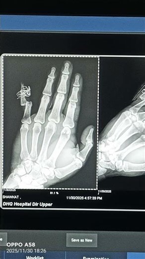 X-Ray of Hand | Labeled Anatomy | Normal Hand Radiograph Explained