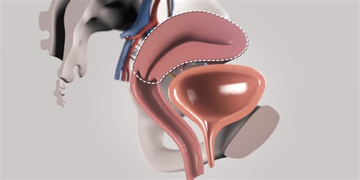 Total Laparoscopic Hysterectomy - TVASurg - The Toronto Video Atlas of Surgery