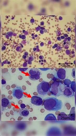 May Grunwald Giemsa stain (MGG)..🫟