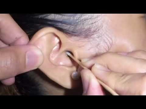 Watch How to Clean Girl's Ear using a Cotton Swab