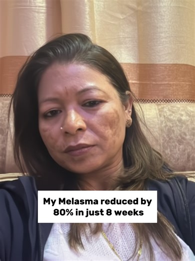 Effective Treatments for Melasma Improvement