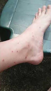 Chigger Cure NO BS