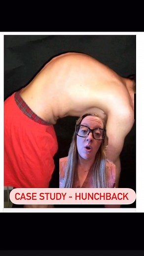Case study #46 - hunchback 19yo male presents to my office with mid back pain and symptoms of hunchback. What do you think the diagnosis is? What would be the treatment in his case? Does he need surgery? Stay tuned tomorrow and I’ll explain everything. #neurosurgery #casestudy #sundaycasestudy #ladyspinedoc #spinesurgery #hunchback #healthcareworker #hospital #surgery #neurosurgeon #medicalschool #medstudent #medicalstudent #nursing #pastudent #paschool #nursingschool #learnonreels | Dr. Betsy G