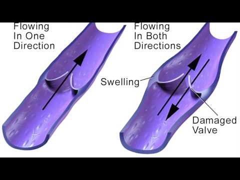 What are venous stasis leg ulcers? Complications of Venous Insufficiency | Texas Endovascular
