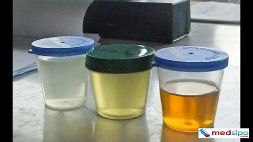 GGT Test (Gamma Glutamyl Transferase Test - Normal Range, Sample)