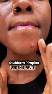 2.5M views · 6.3K reactions | This video went viral. The most liked video. Do you have pimples? Use this. #fypシ #fbpostviral #foryouシ #skincare #NaturalBeauty #antiaging #pimples #acne #reelsvideoシ | Aroma Talks | Facebook