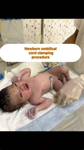 Newborn umbilical cord clamping procedure✂️✂️📤⛑️ #nurse #medicalstudent #medical