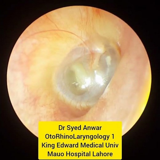Atrophic Tympanic membrane | Thinning of tympanic membrane | Retraction pockets | Endoscopy