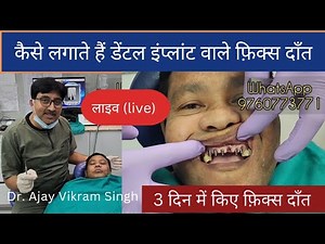 Dental implant live procedure, कैसे लगते हैं इंप्लांट, Dr Ajay vikram Singh Agra