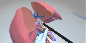 VR update: Surgical simulation module - TVASurg - The Toronto Video Atlas of Surgery
