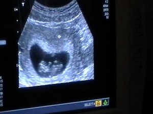 10 week ultrasound